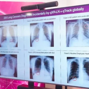 AI Jadi Mata yang Bisa Melihat dan Deteksi Kanker Paru-paru