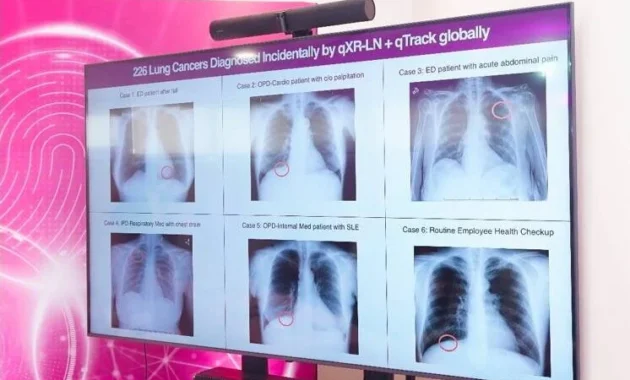 AI Jadi Mata yang Bisa Melihat dan Deteksi Kanker Paru-paru AI Jadi Mata yang Bisa Melihat dan Deteksi Kanker Paru-paru