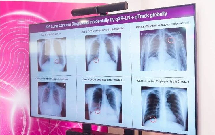 AI Jadi Mata yang Bisa Melihat dan Deteksi Kanker Paru-paru