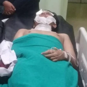 Bagian Mata Luka Parah Akibat Siraman Air Keras, Andrie Yunus Terancam Cacat Permanen