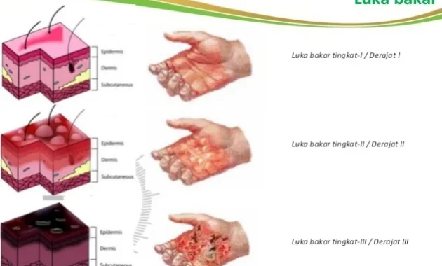 Balita 14 Bulan Meninggal Akibat Luka Bakar, Ibu Ungkap Kronologi dan Tuduhan Kelalaian Medis