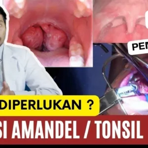 Merinding! Abew Operasi Amandel, Proses Operasi Bikin Tegang