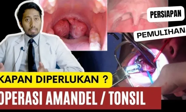 Merinding! Abew Operasi Amandel, Proses Operasi Bikin Tegang
