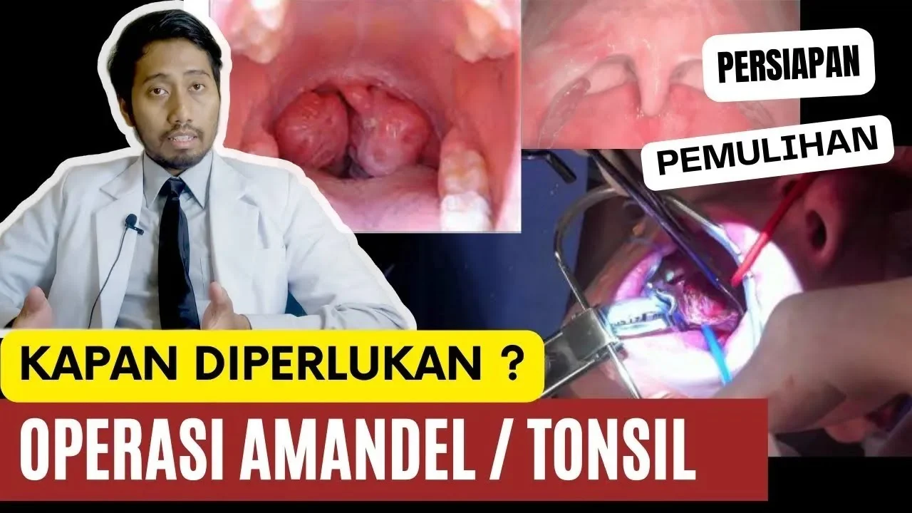 Merinding! Abew Operasi Amandel, Proses Operasi Bikin Tegang