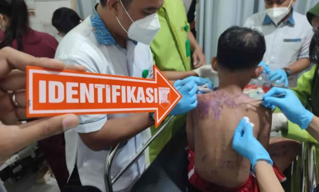 Viral Ibu Korban Penyiraman Air Keras di Johar Baru Marah Pelaku Tak Ditahan, Polisi Jelaskan Status Hukum Pelaku