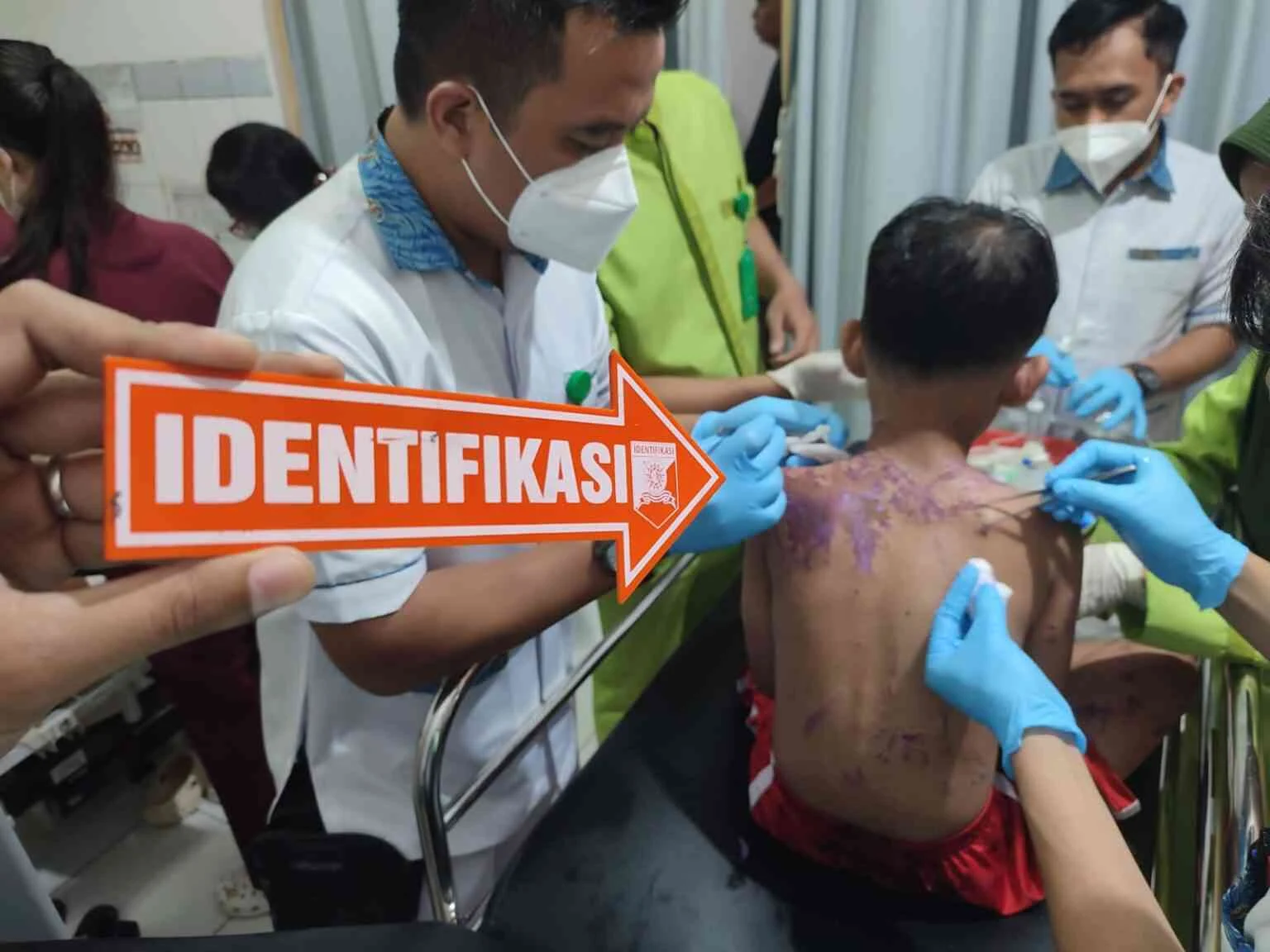 Viral Ibu Korban Penyiraman Air Keras di Johar Baru Marah Pelaku Tak Ditahan, Polisi Jelaskan Status Hukum Pelaku