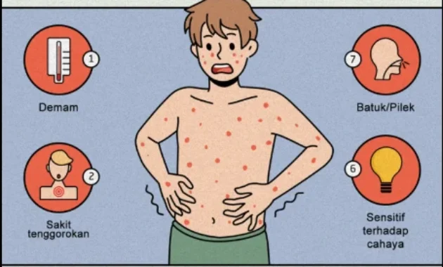 Virus Campak Menular Sebelum Gejala Muncul: PAPDI Tekankan Urgensi Vaksinasi untuk Lindungi Anak Virus Campak Menular Sebelum Gejala Muncul: PAPDI Tekankan Urgensi Vaksinasi untuk Lindungi Anak