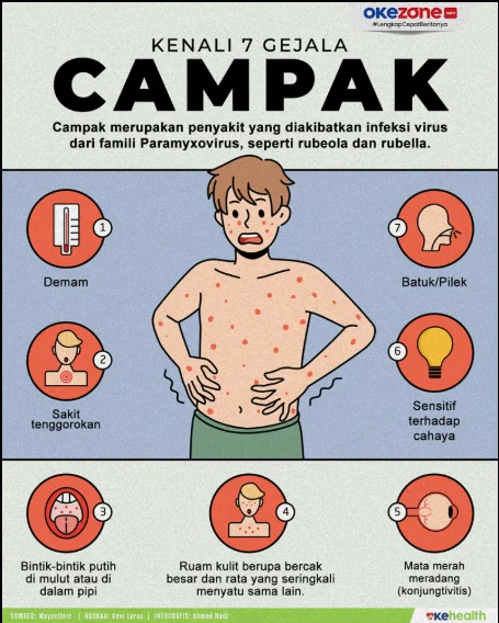 Virus Campak Menular Sebelum Gejala Muncul: PAPDI Tekankan Urgensi Vaksinasi untuk Lindungi Anak