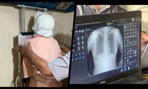 Dinkes Kota Malang Gencarkan Screening Mobile untuk Tekan Penyebaran TBC