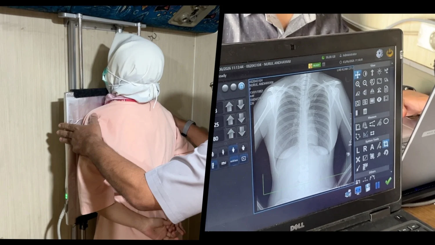 Dinkes Kota Malang Gencarkan Screening Mobile untuk Tekan Penyebaran TBC