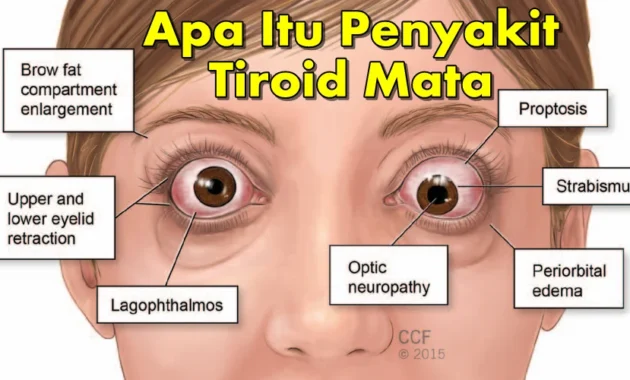 Mata Melotot, Tanda Khas Gangguan Mata pada Penyakit Tiroid