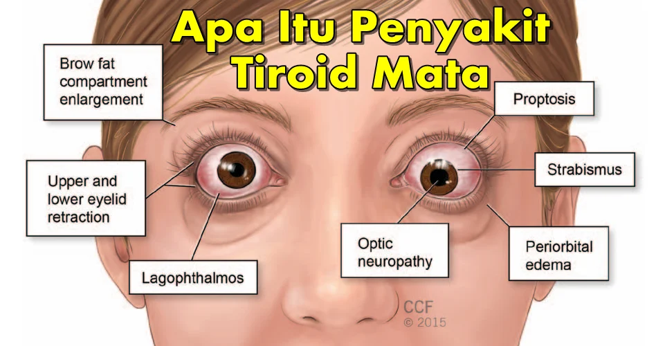 Mata Melotot, Tanda Khas Gangguan Mata pada Penyakit Tiroid